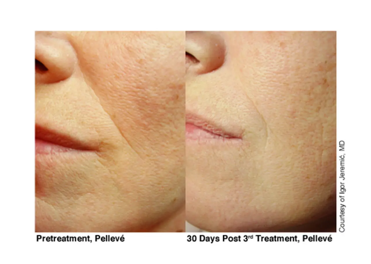 marketing_materials_7-Pelleve Before & After Treatment Photos (image 6)