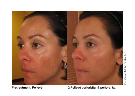 marketing_materials_John Burke, MD (Left Side) 2 Pellevé periorbital & perioral tx_